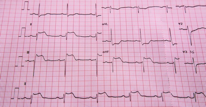 EKG - STEMI - ST pazīmes un sirds muskuļa infarkts