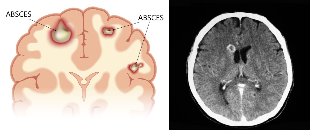 Smadzeņu abscesa anatomiskie skati un datortomogrāfija