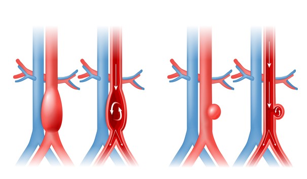 Aortas aneirisma un asins plūsma