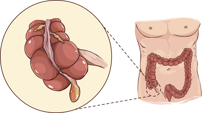 Pielikums - anatomisks attēlojums resnās zarnas sākumā