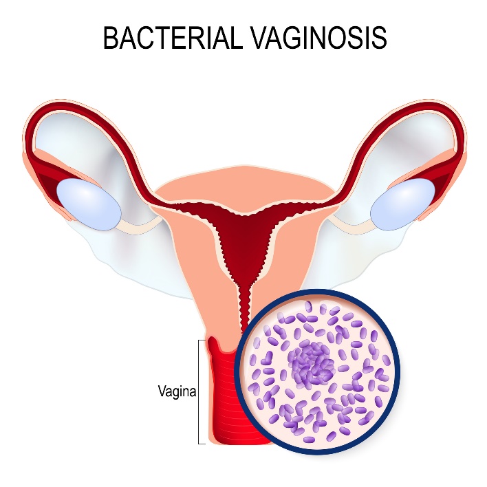 Bakteriālā vagineloze un Gardnerella vaginalis aizaugšana