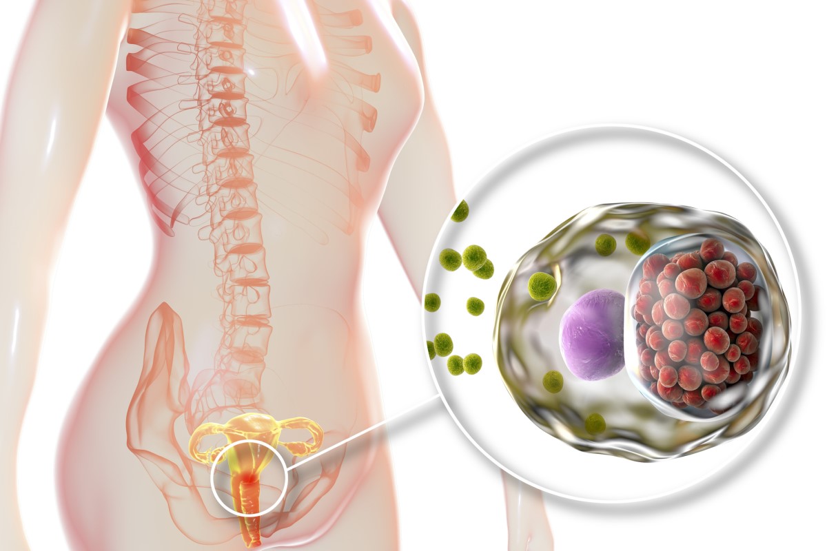 Infekcija ir iebrukusi dzemdes kakliņā - anatomiskā sieviešu reproduktīvās sistēmas reprezentācija.