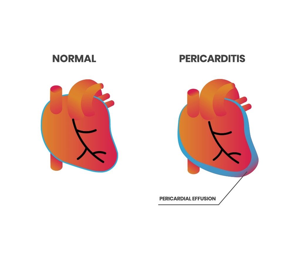 Sirds fizioloģija un perikardīts (perikarda izsvīdums)