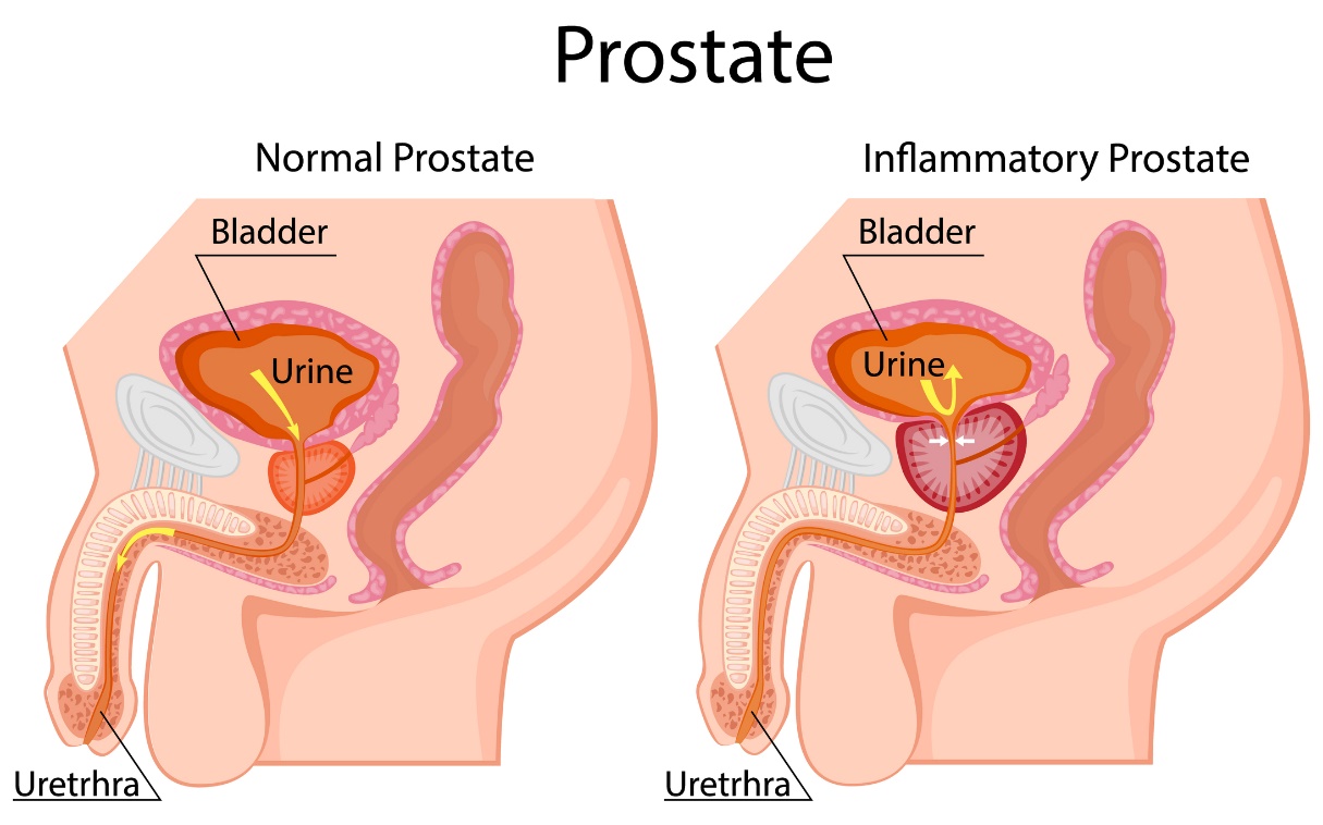 Kreisajā pusē: fizioloģiska prostata. Pa labi: palielināta prostata. Atrodas zem urīnpūšļa. Urīnpūšlis, urīns, urīnizvadkanāls.