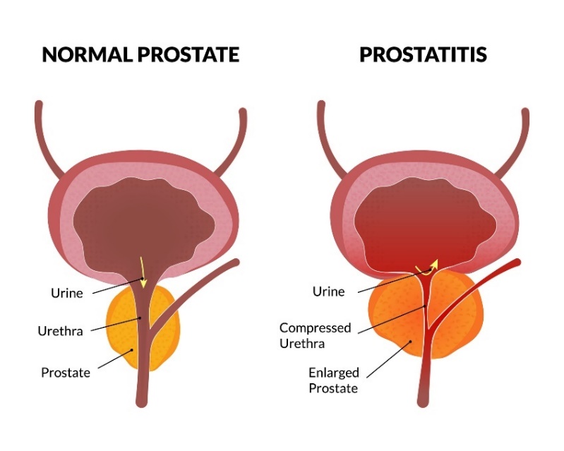 Prostatas fizioloģiskais stāvoklis un prostatīts