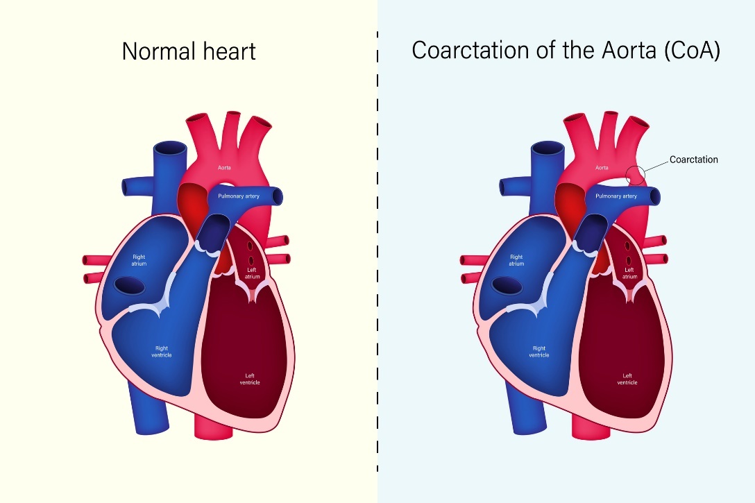 Sirds un aortas koarktācijas (CoA) fizioloģiskais stāvoklis