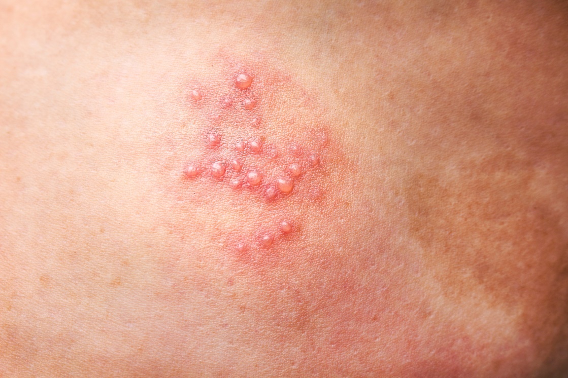 Dzimumorgānu herpes