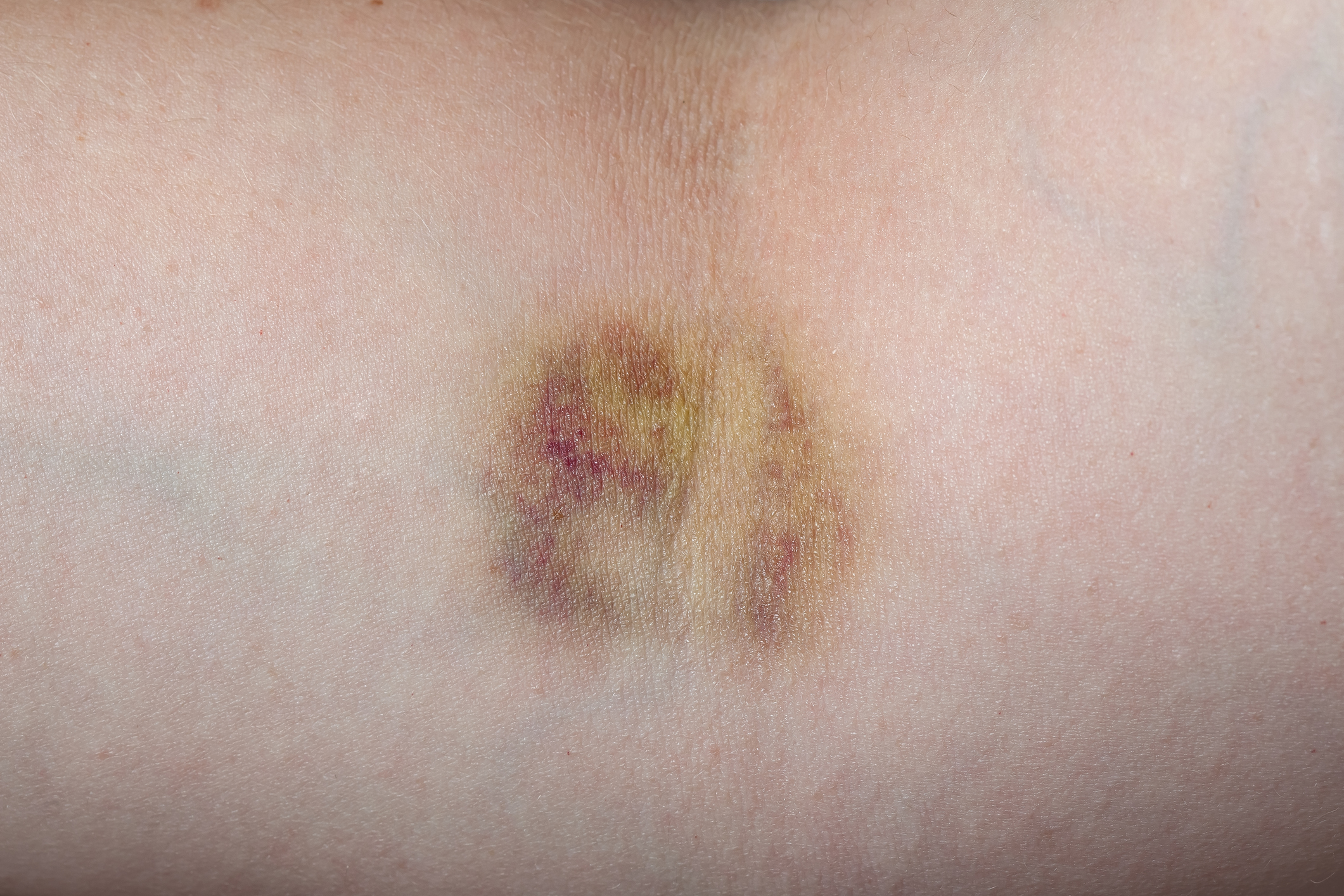 Hematoma (zilums)