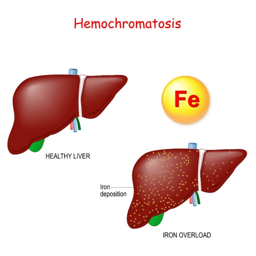 Hemohromatoze: aknu fizioloģija un patoloģija ar pārmērīgu dzelzs (Fe) nogulsnēšanos.