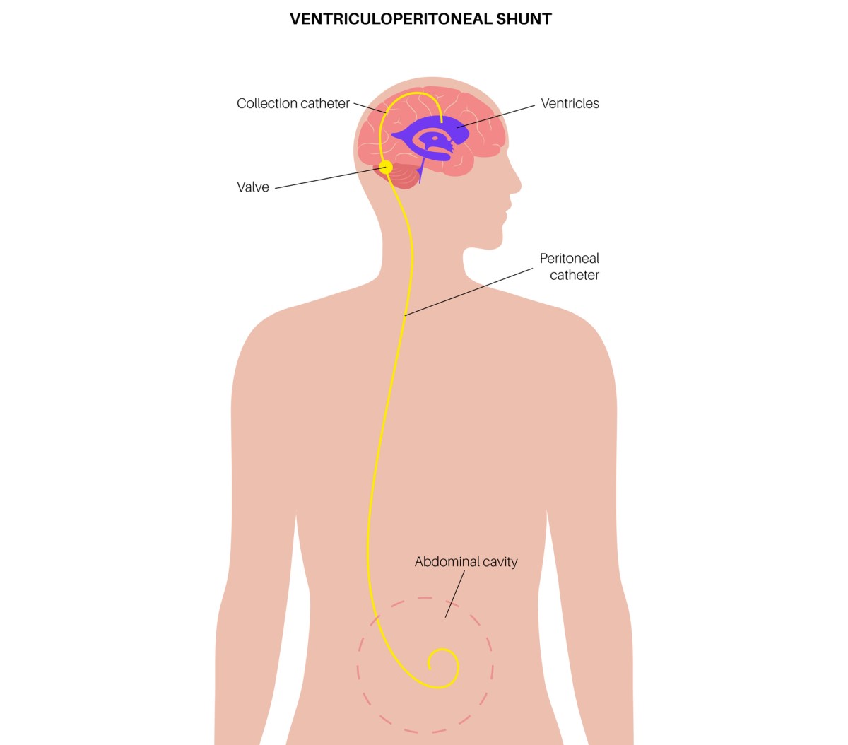 Ventrikuloabdominālā šunta ilustrācija, kas novada lieko šķidrumu no smadzenēm uz vēdera dobumu.