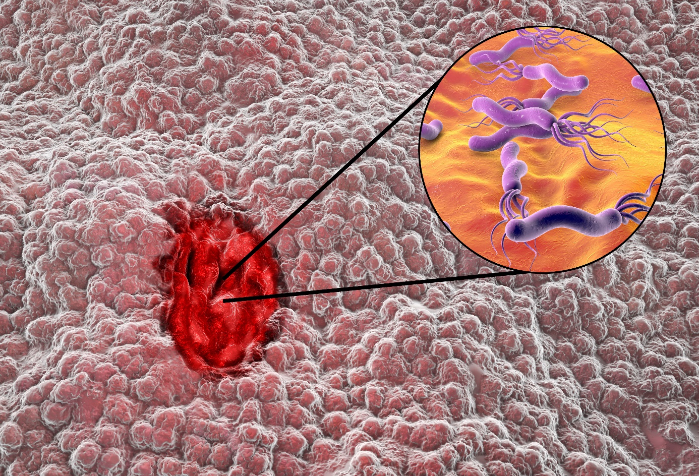 Helicobacter pylori infekcija