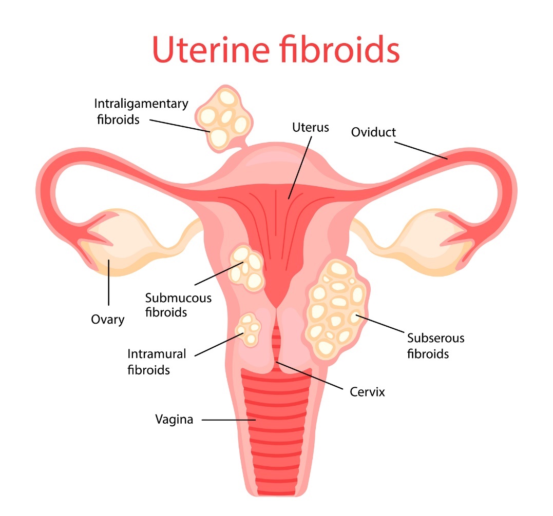 Dzemdes fibroidi (dzemdes fibroīdi)