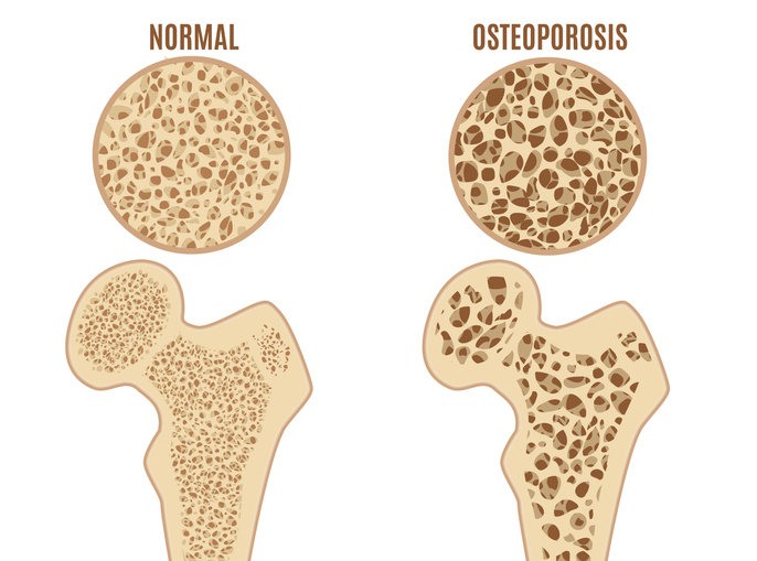 Ciskas augšstilba kaula osteoporoze