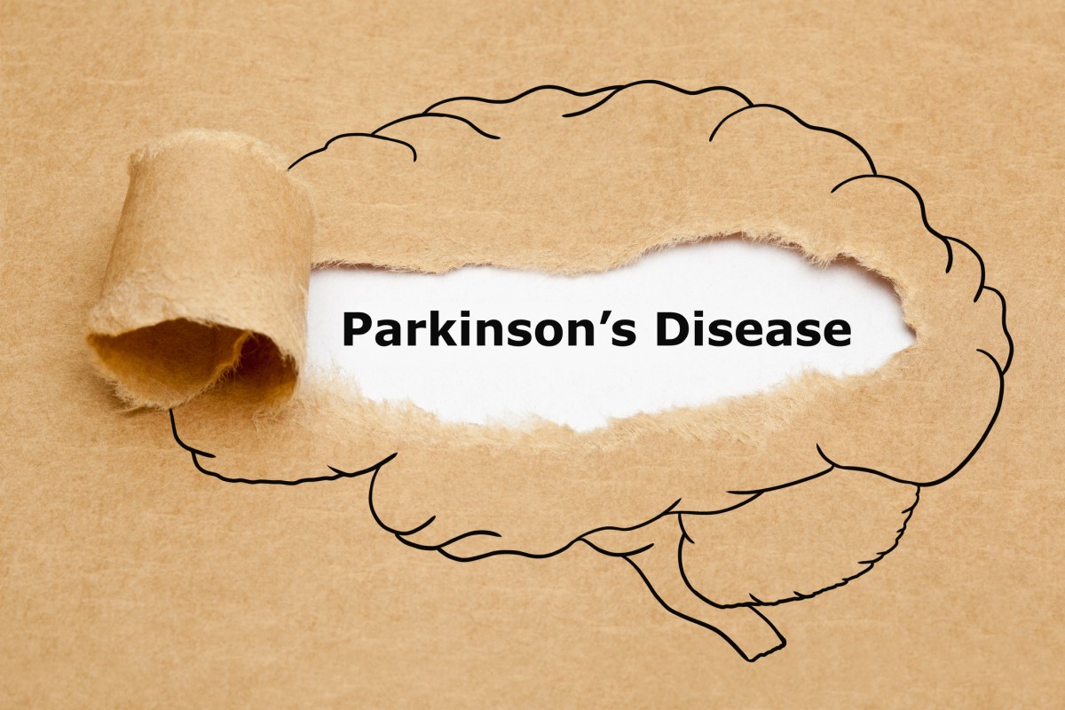 Morbus parkinson = Parkinsona slimība = Parkinsona slimība - smadzeņu animācija ar Parkinsona slimību vidū