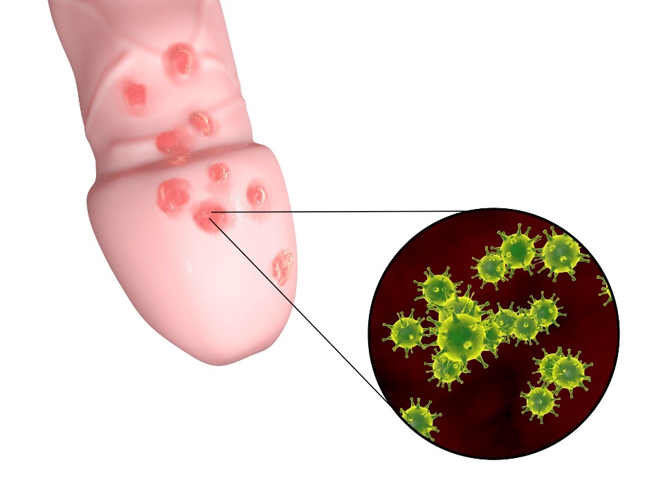 Mazu dzimumorgānu herpes pūslīšu veidošanās vīrieša dzimumorgānu zonā.