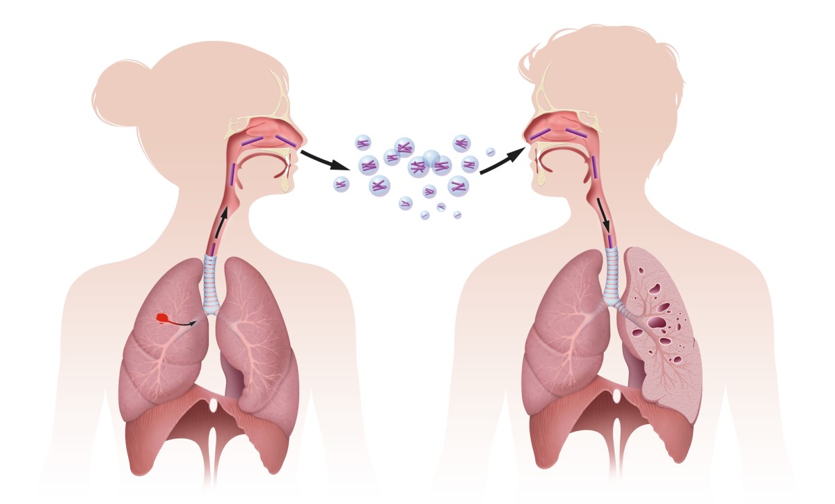 Tuberkulozes pārnešana inhalācijas ceļā, t. i., ieelpojot, attēlā parādīta tuberkulozes pārnešana inhalācijas ceļā.