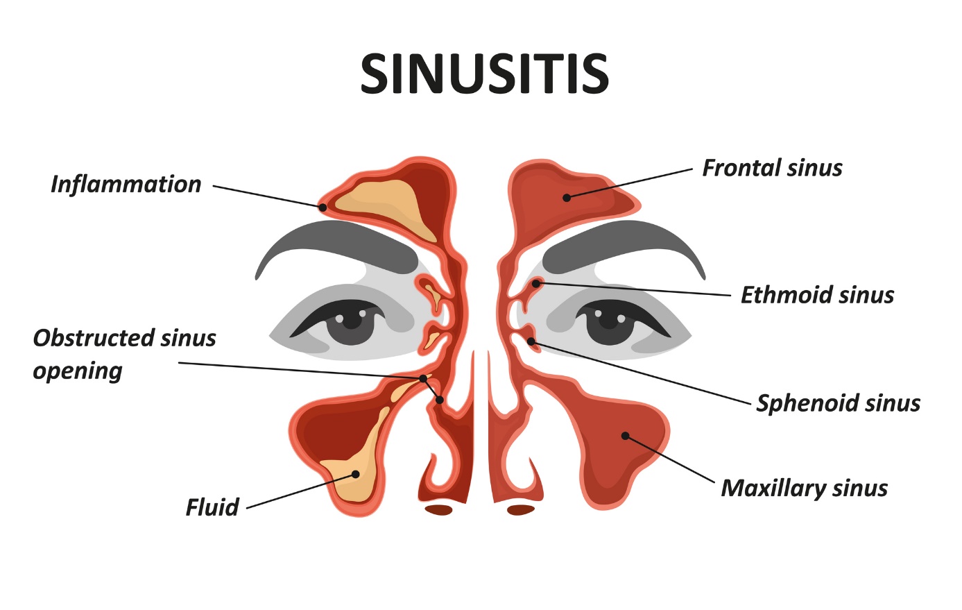 Sinusīta un sinusīta animēts modelis/attēls