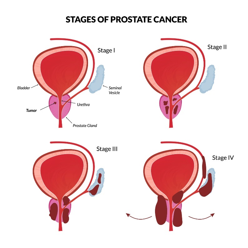 Prostatas vēža 4 galvenās stadijas