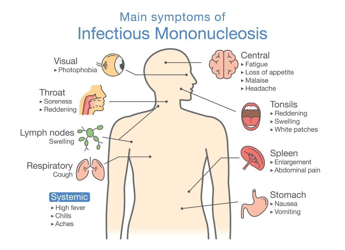 Infekciozās mononukleozes simptomi