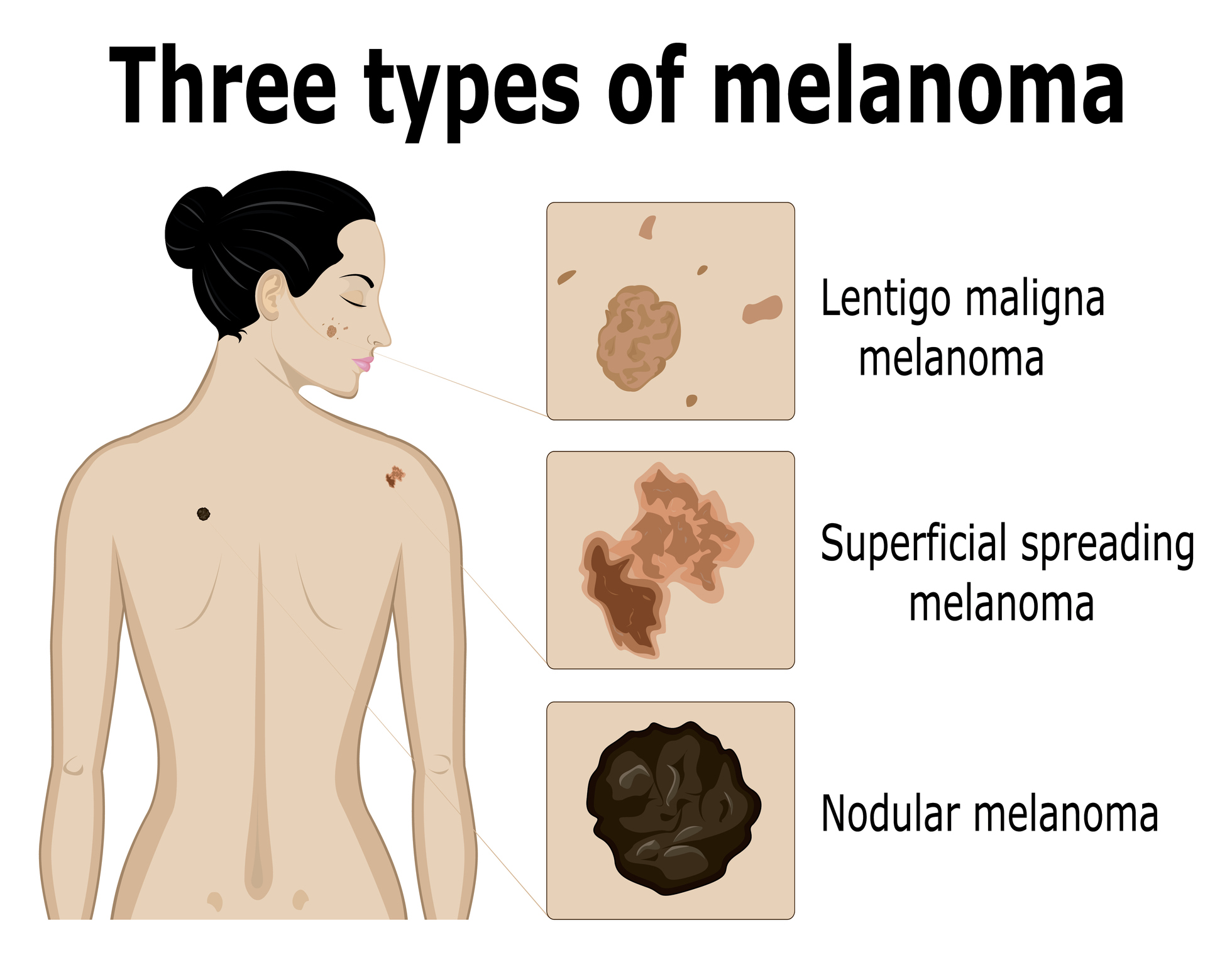 Trīs melanomas veidu attēlveidošana