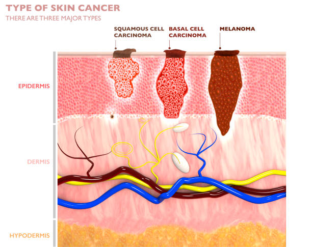 Ādas audzēju veidi, to iekļūšana ādā - plakanšūnu karcinoma, bazalioma un melanoma.