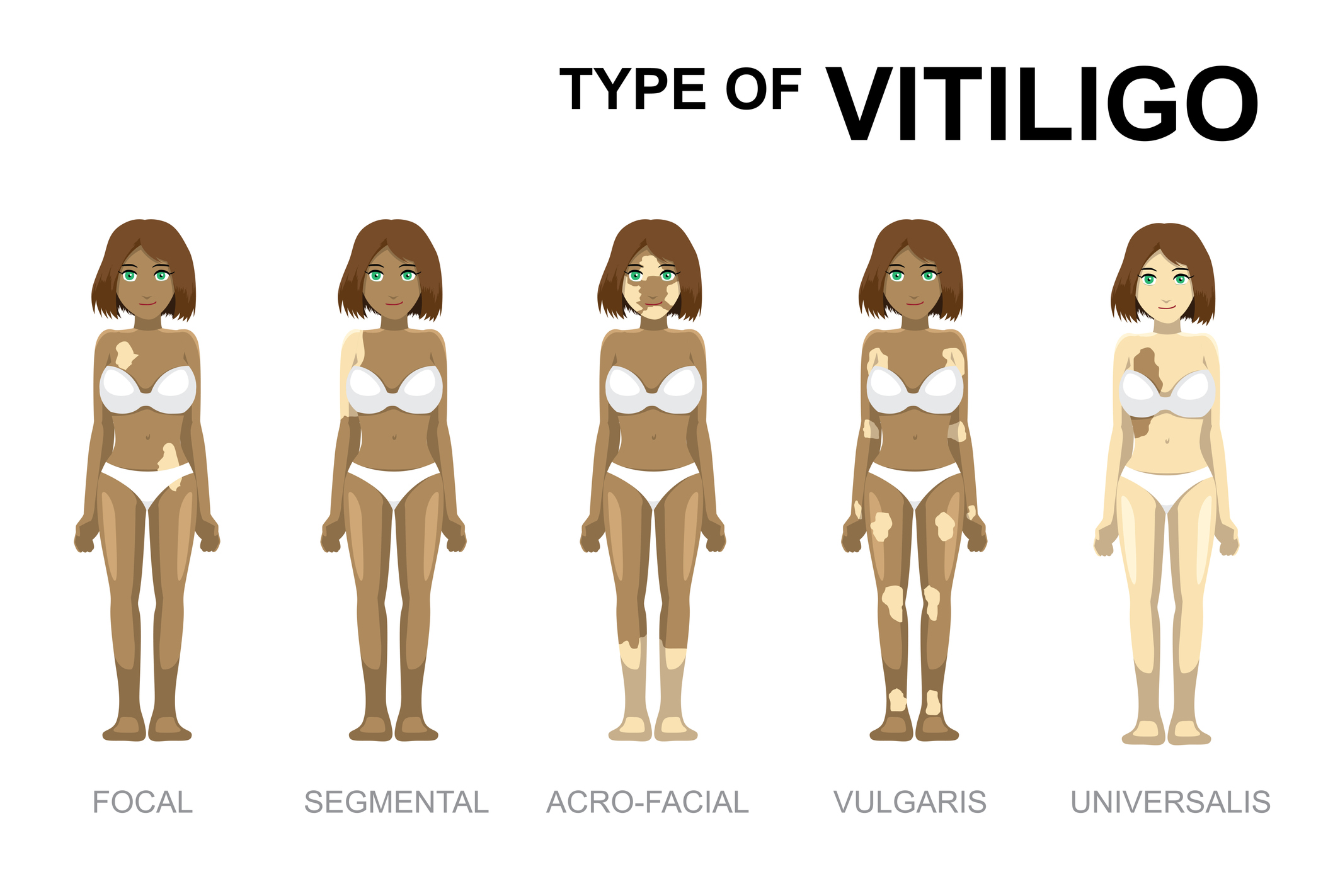 Vitiligo veidi