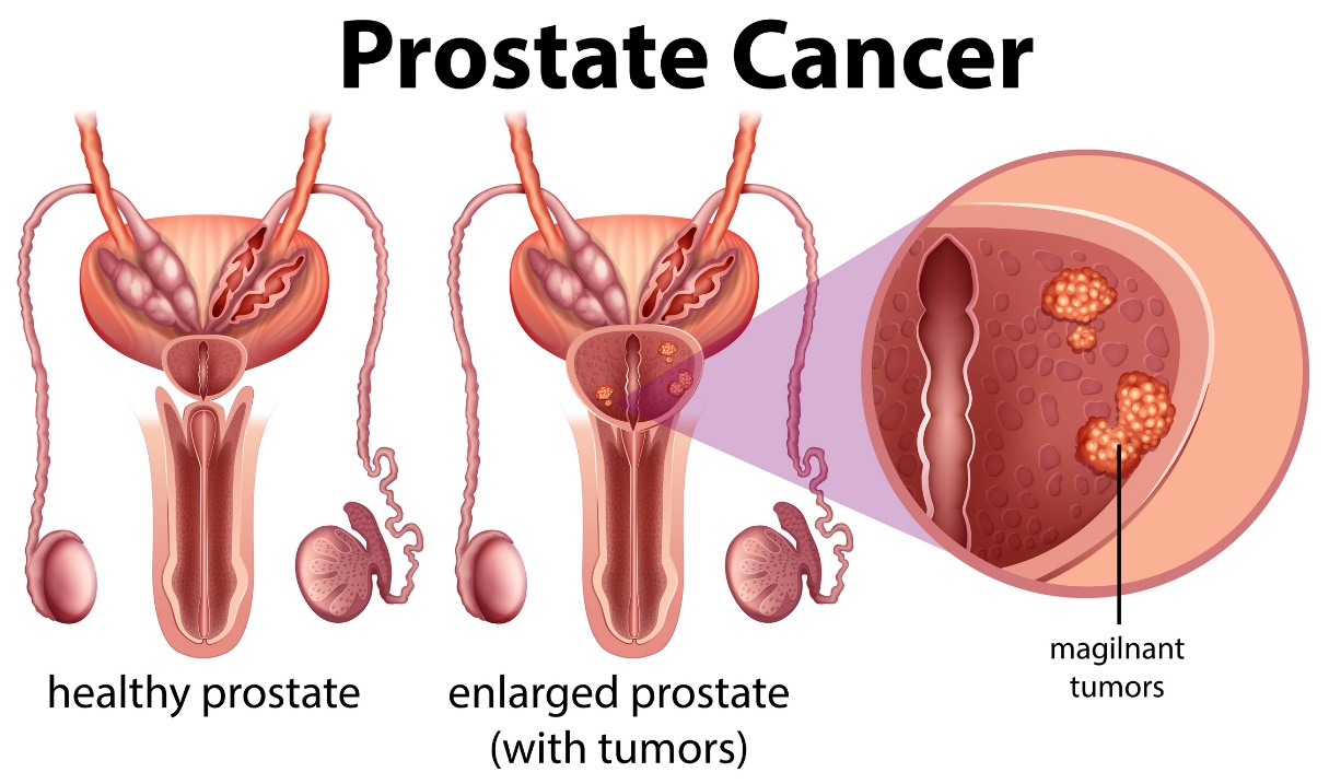 Prostatas vēzis. Veselīga prostatas un palielinātas prostatas ar audzēju.