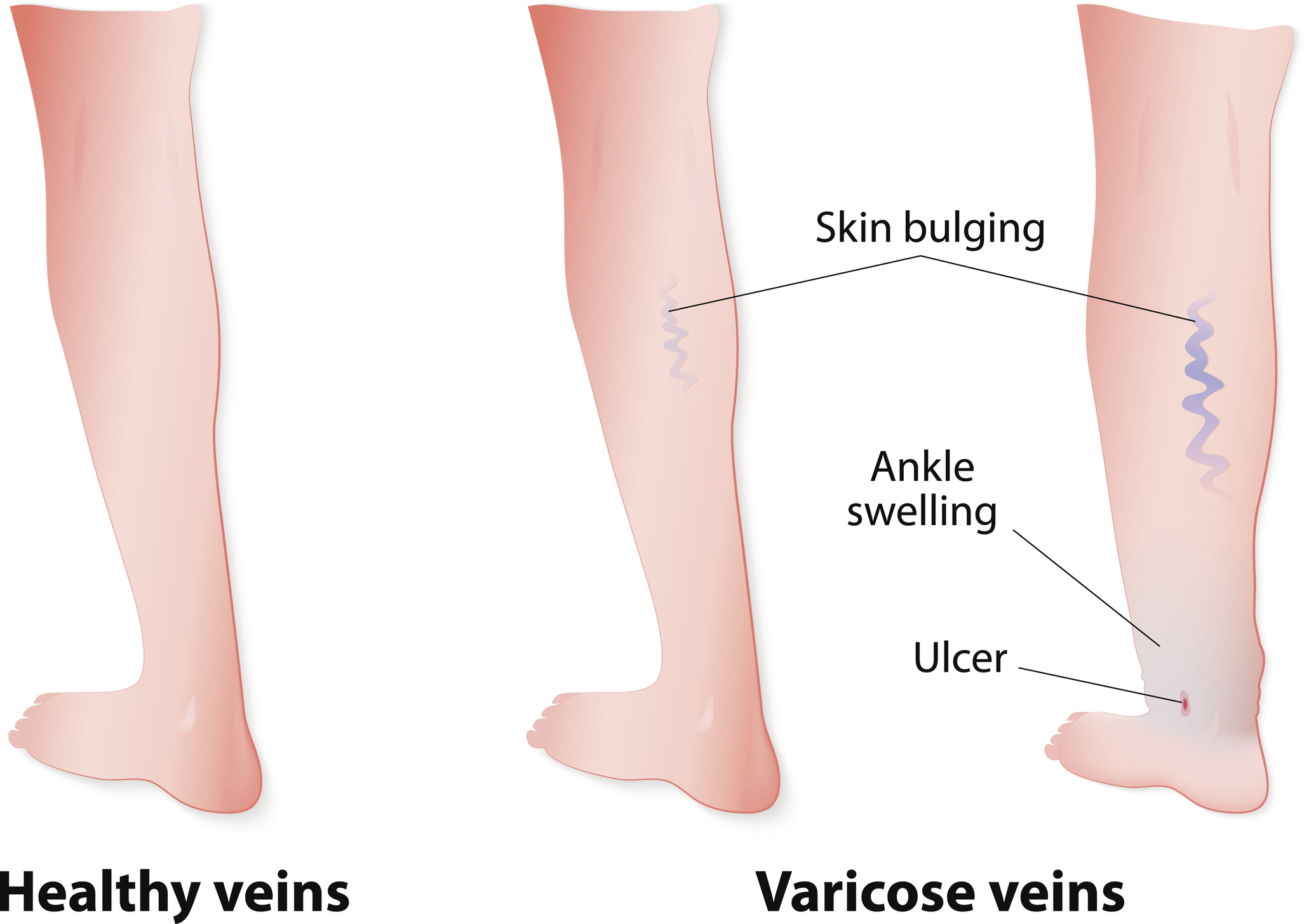 Ilustrācija čūlas veidošanās