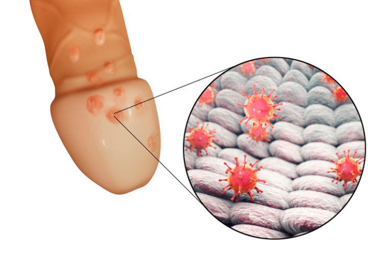 dzimumorgānu herpes uz dzimumlocekļa un herpes vīruss mikroskopiskā līmenī