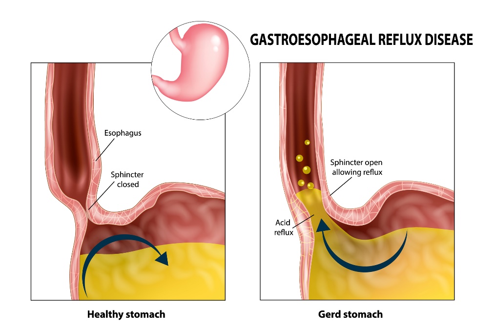 Gastroezofageālais reflukss: barības vads, sfinkters, kuņģis un kuņģa skābe.