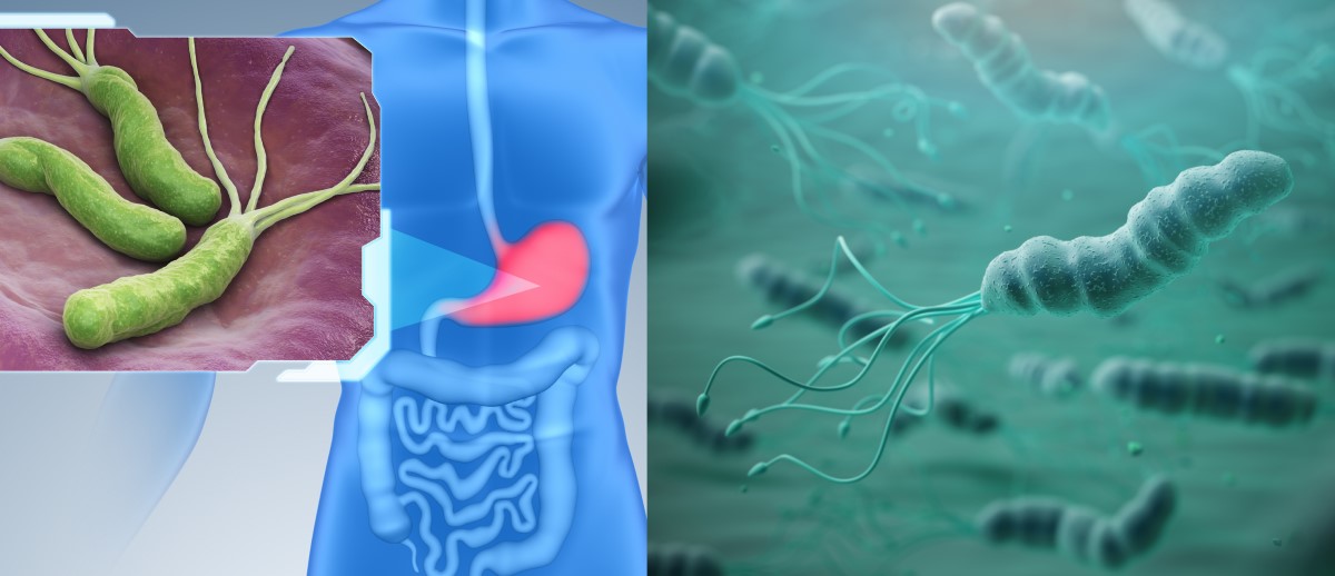 Helicobacter pylori kolonizē kuņģa gļotādu un ir gastrīta, čūlas slimības un vēža riska faktors.