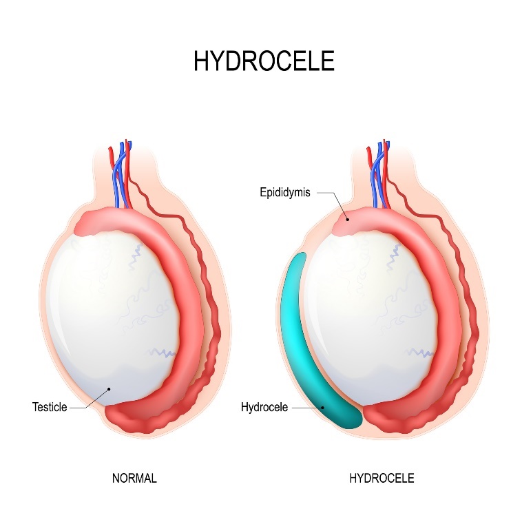 Hidrocele: sēklinieks, Epidididimis (epididimis), Hidrocele (uzkrātais šķidrums)