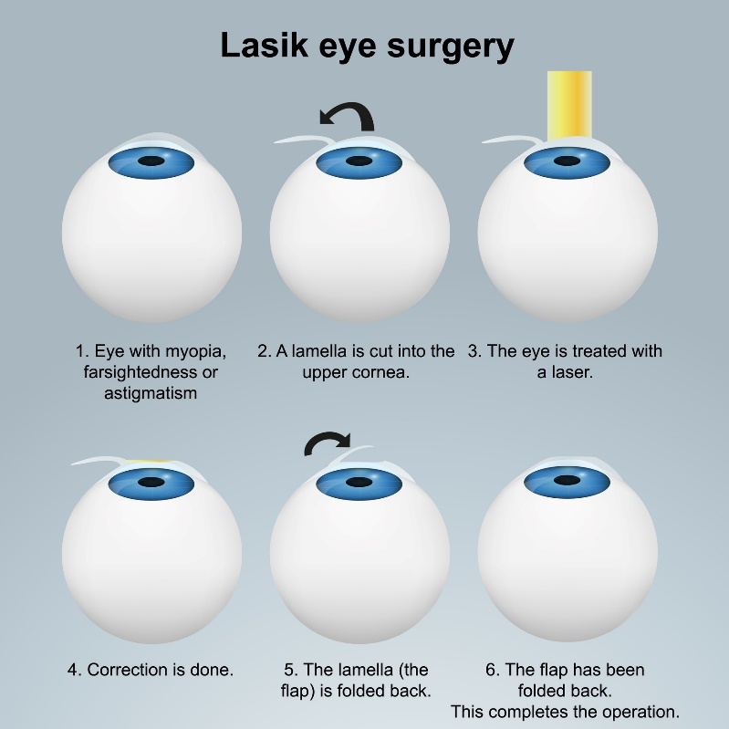 LASIK lāzera acu ķirurģija - zemvirsmas metode. Procedūra ar lāpstiņu/plākšņu palīdzību, nebojājot nervu galus.