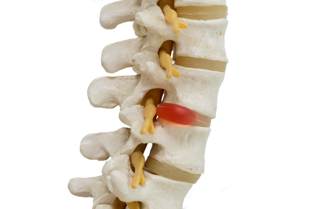 Mugurkaula, starpskriemeļu disku un diska trūces ar nervu kompresiju anatomisks 3D modeļa anatomisks attēlojums