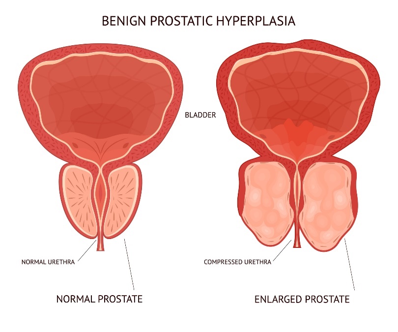 labdabīga prostatas palielināšanās. Prostatas orgāna fizioloģiskais un palielinātais urīnpūslis.