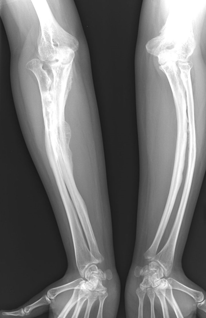 Pieauguša cilvēka osteogenesis imperfecta slimības rentgenogrammas