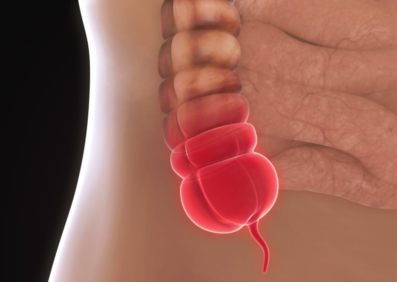 Iekaisis apendiksa modelis - anatomisks skats