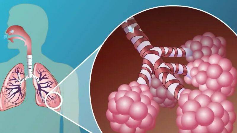 Hroniska obstruktīvā plaušu slimība: kāpēc tā rodas un kam ir risks saslimt?