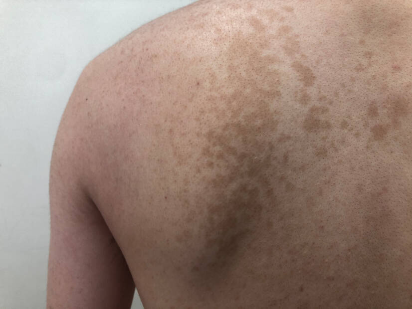 Pityriasis versicolor: kas tas ir un kādi ir tā simptomi? Cēloņi un transmisija