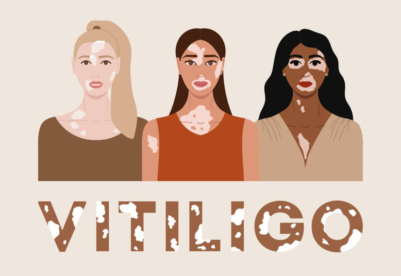 Vitiligo: Kas ir vitiligo, kādi ir tā cēloņi un simptomi? Kad tas sākas?